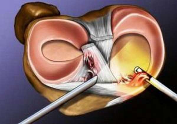 Артроскопия сустава колена